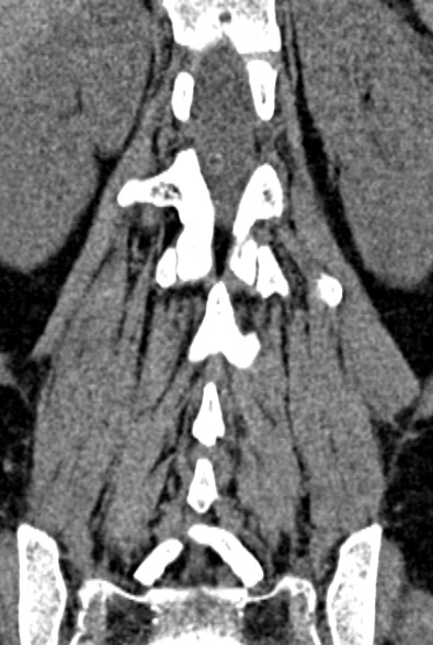 Normal CT lumbar spine (Radiopaedia 53981-60118 F 68).jpg