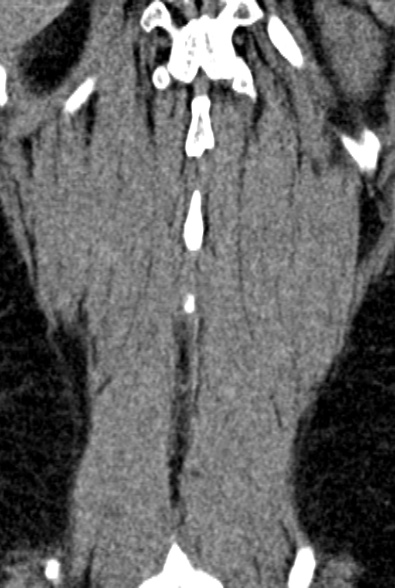 Normal CT lumbar spine (Radiopaedia 53981-60118 F 91).jpg