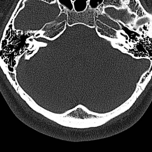 File:Normal CT of the cervical spine (Radiopaedia 53322-59305 Axial bone window 5).jpg