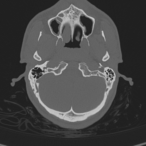Normal CT skull (Radiopaedia 40798-43459 A 22).png