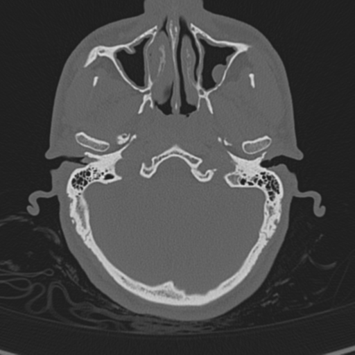 Normal CT skull (Radiopaedia 40798-43459 A 30).png