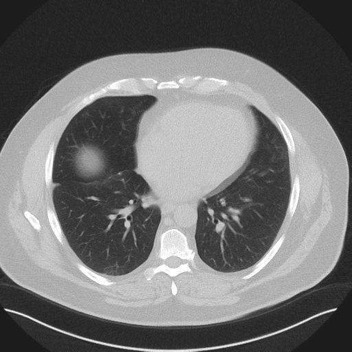 Normal HRCT (Radiopaedia 40797-43458 Axial lung window 37).png