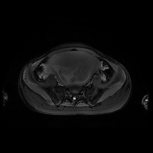 File:Normal MRI abdomen in pregnancy (Radiopaedia 88001-104541 D 41).jpg