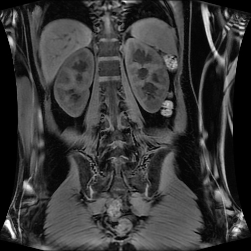 Normal MRI abdomen in pregnancy (Radiopaedia 88001-104541 M 103).jpg