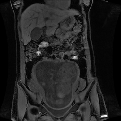 Normal MRI abdomen in pregnancy (Radiopaedia 88001-104541 M 57).jpg