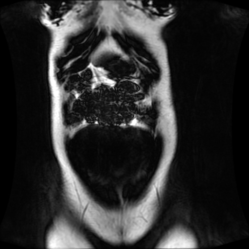 Normal MRI abdomen in pregnancy (Radiopaedia 88001-104541 N 33).jpg