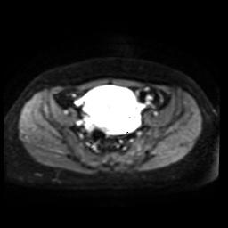 Normal MRI abdomen in pregnancy (Radiopaedia 88005-104548 Axial DWI 22).jpg