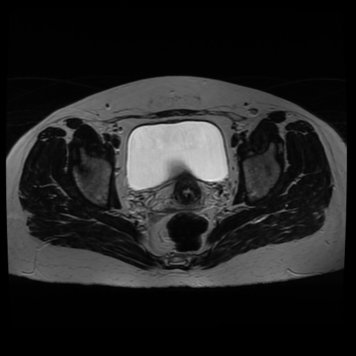 Normal MRI abdomen in pregnancy (Radiopaedia 88005-104548 Axial T2 34).jpg