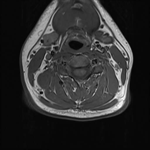 File:Normal MRI cervical spine (infection protocol) (Radiopaedia 53916-60039 Axial 25).png