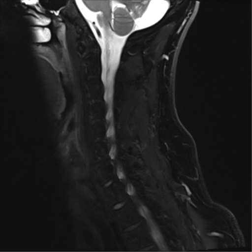 File:Normal MRI cervical spine (infection protocol) (Radiopaedia 53916-60039 Sagittal Dixon 11).png