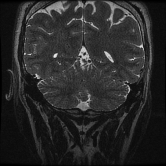 Normal MRI petrous (Radiopaedia 91317-108949 Coronal T2 114).jpg
