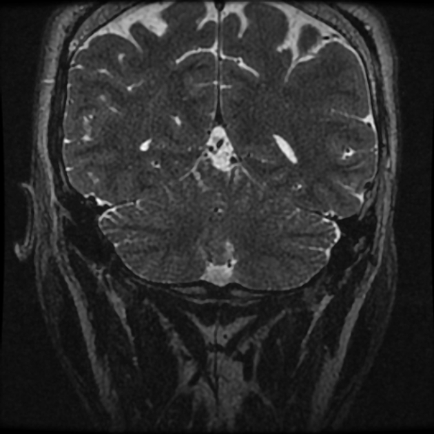 Normal MRI petrous (Radiopaedia 91317-108949 Coronal T2 116).jpg