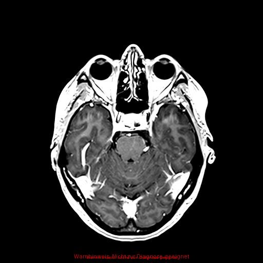 Normal adult brain MRI (non-enhanced and contrast-enhanced) (Radiopaedia 75262-86379 Axial T1 C+ 81).jpg