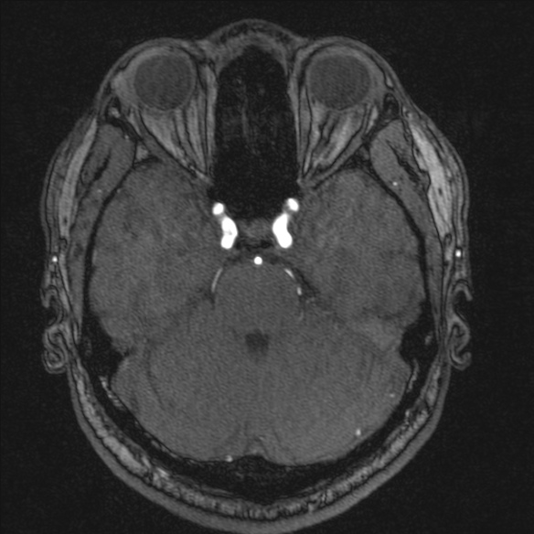 Normal brain MRI including MRA (Radiopaedia 48748-53763 Axial MRA 63).jpg