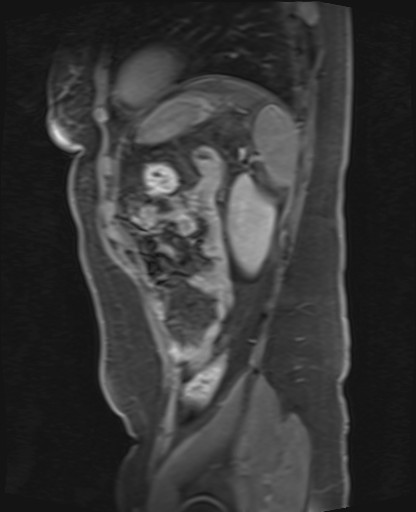 File:Normal hepatobiliary phase liver MRI (Radiopaedia 58968-66230 C 64).jpg