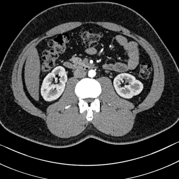 Normal kidneys on 4-phase CT study (Radiopaedia 25889-26038 B 53).jpg