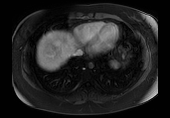 Normal liver MRI with Gadolinium (Radiopaedia 58913-66163 J 71).jpg