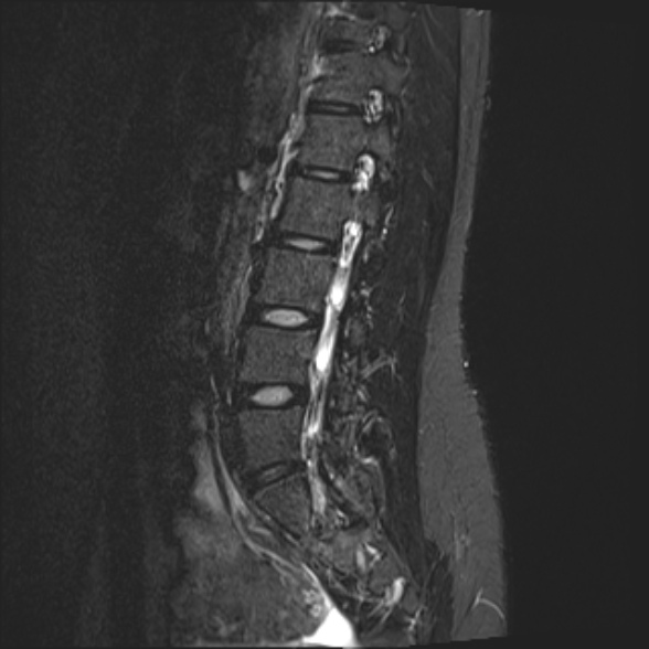 File:Normal lumbar spine MRI- 3 T (Radiopaedia 53280-59250 Sagittal STIR 17).jpg