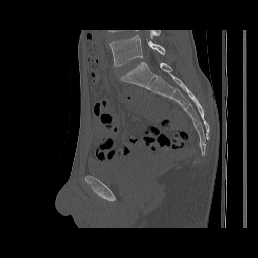 Normal pelvis (Radiopaedia 51473-57238 Sagittal bone window 72).jpg
