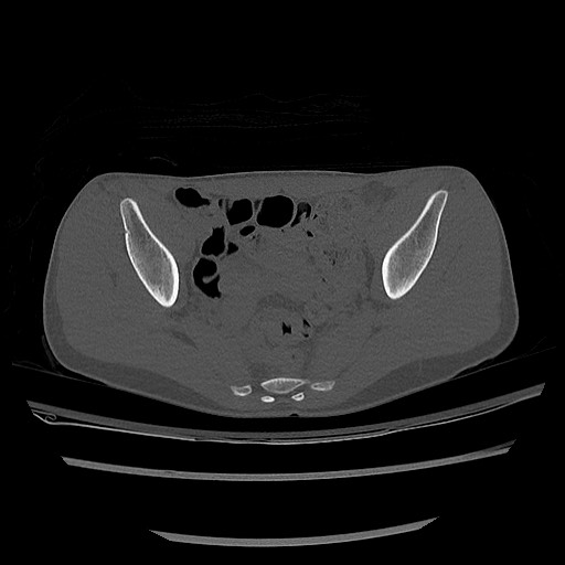 Normal pelvis CT (Radiopaedia 51471-57236 Axial bone window 53).jpg
