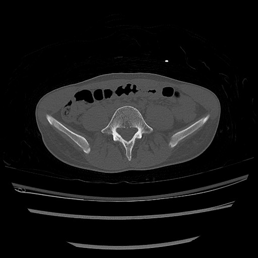 Normal pelvis CT (Radiopaedia 51471-57236 Axial bone window 9).jpg