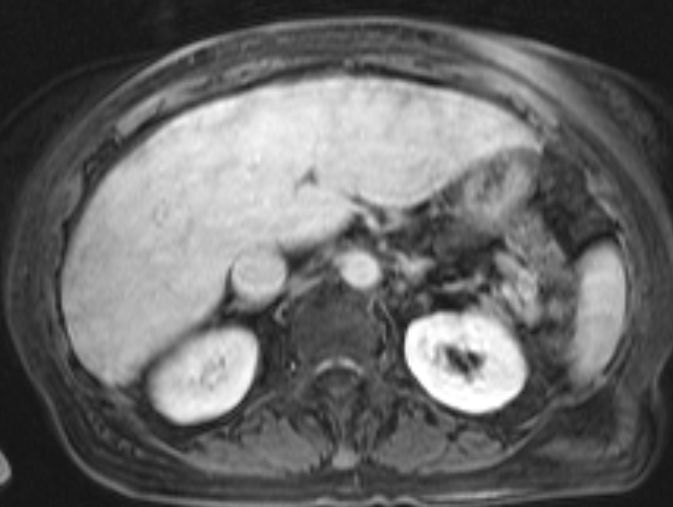 File:Nutmeg appearance of the liver (Radiopaedia 22879-22904 Axial 3).jpg