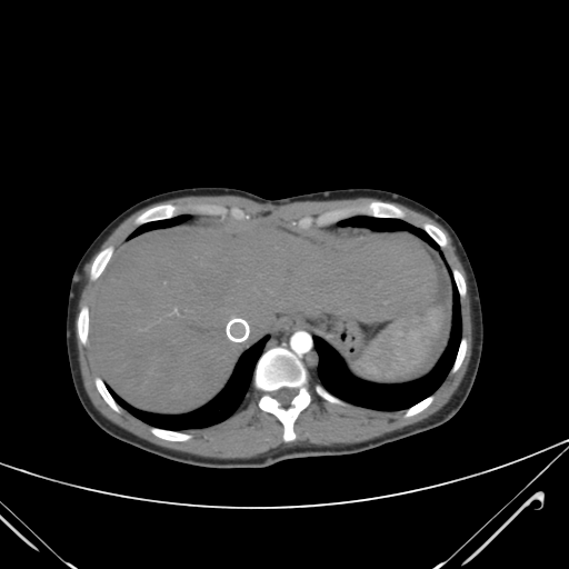 File:Nutmeg liver- Budd-Chiari syndrome (Radiopaedia 46234-50635 A 12).png