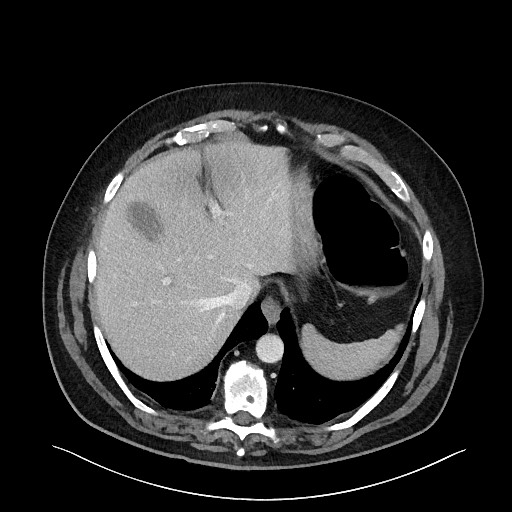 Obstructing sigmoid adenocarcinoma (Radiopaedia 58465-65619 A 29).jpg