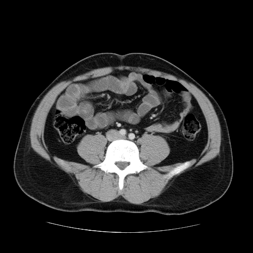 File:Obstructing ureteric calculus (Radiopaedia 18615-18514 B 34).jpg