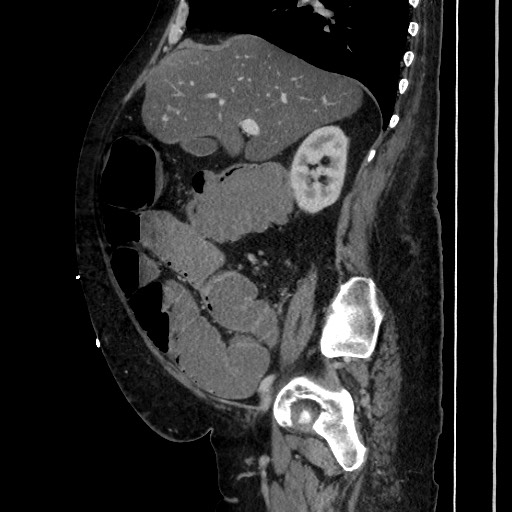 Obstructive colonic diverticular stricture (Radiopaedia 81085-94675 C 91).jpg