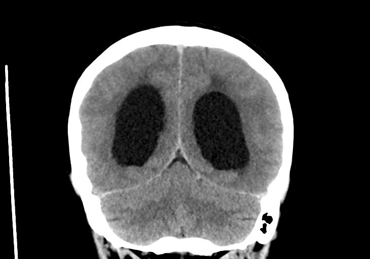 File:Obstructive hydrocephalus (Radiopaedia 30453-31119 Coronal non-contrast 29).jpg
