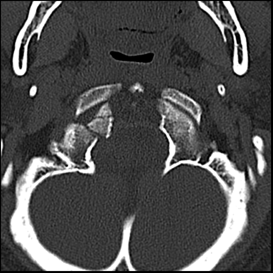 Occipital condyle fracture (type 1) (Radiopaedia 87670-104084 Axial bone window 12).jpg