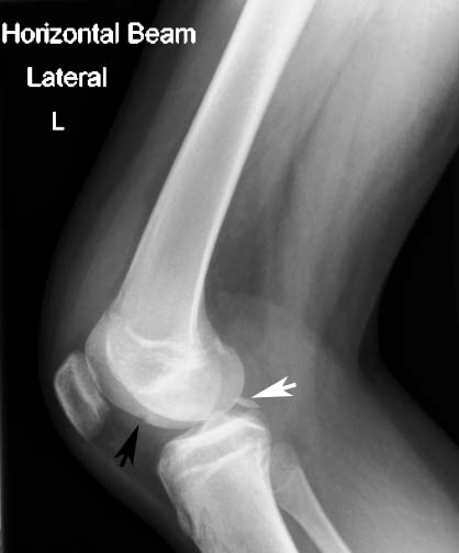 File:Osteochondral defect with intra-articular loose body (Radiopaedia 35966).jpg