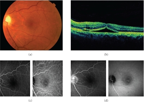 a) Image shows serous retinal detachment b) OCT shows retinal detachment involving the fovea c) early phase images of FA and IA d) Late phase images of FA and IA