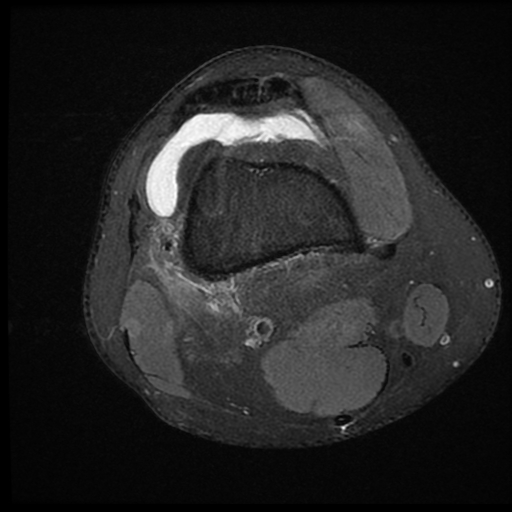 File:ACL acute full thickness tear - deep lateral femoral sulcus sign (Radiopaedia 38594-40740 Axial PD fat sat 6).jpg