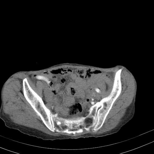 File:Abdominal aortic aneurysm (Radiopaedia 20827-20742 Axial C+ arterial phase 31).jpg