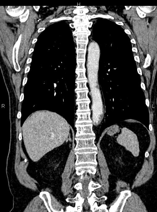 Abdominal aortic aneurysm (Radiopaedia 83094-97462 Coronal renal cortical phase 65).jpg