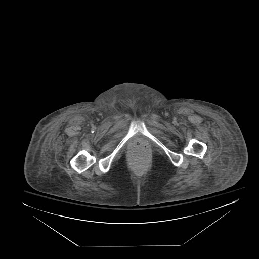 File:Abdominal aortic aneurysm - impending rupture (Radiopaedia 19233-19247 Axial non-contrast 174).jpg