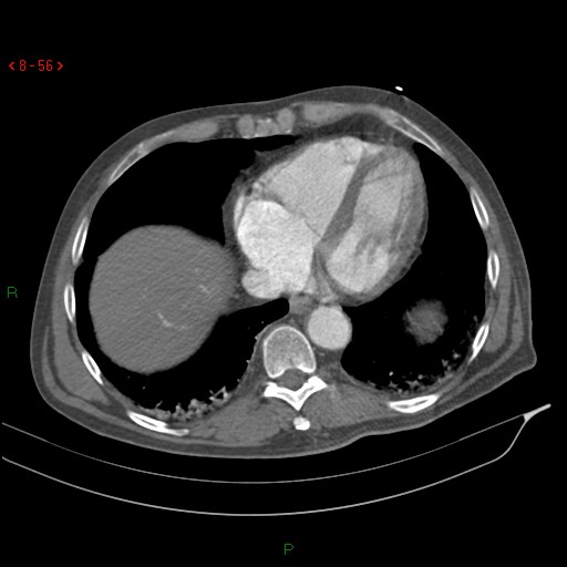 File:Abdominal aortic aneurysm rupture with aortocaval fistula (Radiopaedia 14897-14841 Axial C+ arterial phase 56).jpg
