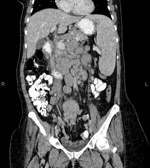 Abdominal lymphoma with sandwich sign (Radiopaedia 84378-99704 Coronal C+ portal venous phase 25).jpg