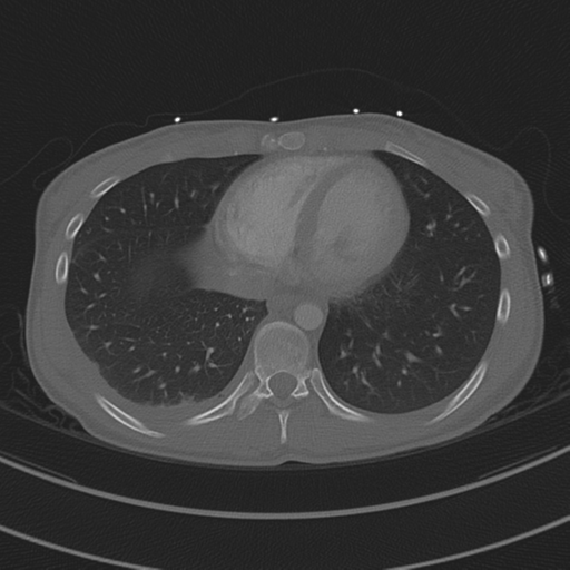 Abdominal multi-trauma - devascularised kidney and liver, spleen and pancreatic lacerations (Radiopaedia 34984-36486 I 62).png