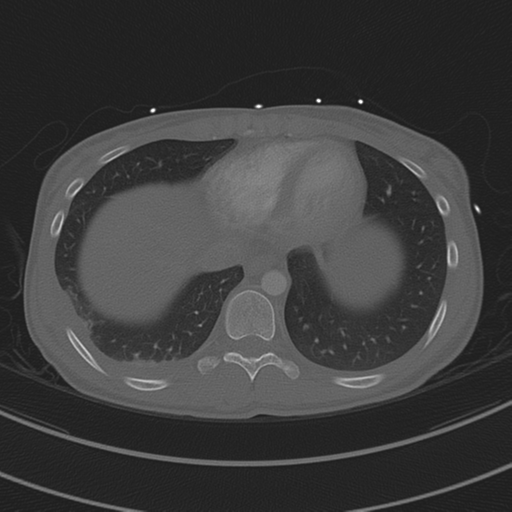 Abdominal multi-trauma - devascularised kidney and liver, spleen and pancreatic lacerations (Radiopaedia 34984-36486 I 66).png