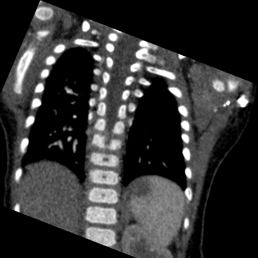 File:Aberrant left pulmonary artery (pulmonary sling) (Radiopaedia 42323-45435 Coronal C+ CTPA 7).jpg