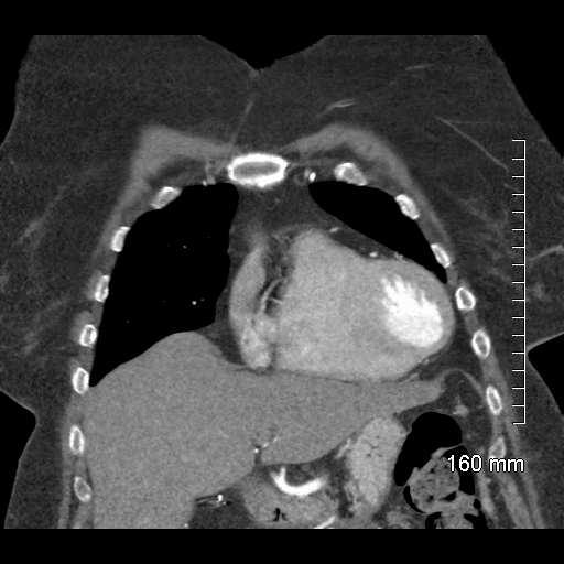 Aberrant right subclavian artery stenosis (Radiopaedia 52656-58670 B 27).jpg