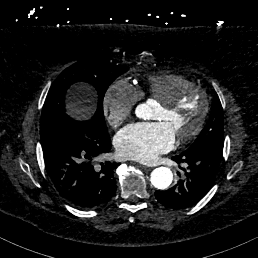 Aberrant right subclavian artery with Kommerell diverticulum (Radiopaedia 47982-52769 Axial C+ arterial phase 57).png