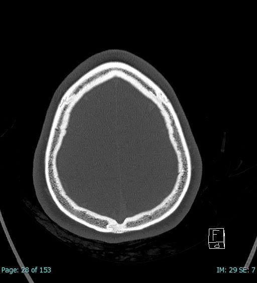 Abscess of the pinna (Radiopaedia 68868-78598 Axial bone window 4).jpg