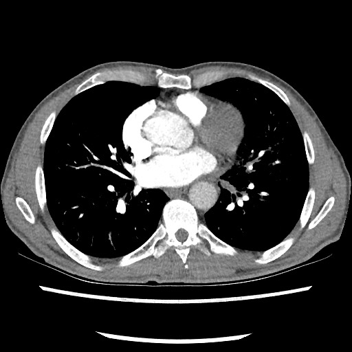 Accessory left horizontal fissure with lingular pneumonia (Radiopaedia 53763-59843 Axial C+ CTPA 55).jpg