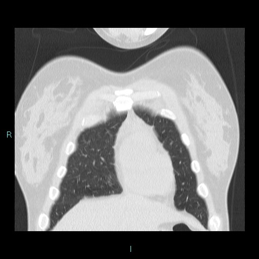 Accidental foreign body aspiration (seamstress needle) (Radiopaedia 77740-89983 Coronal lung window 55).jpg