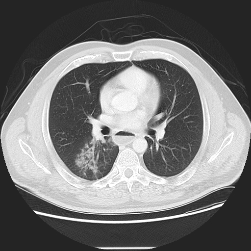 Achalasia (Radiopaedia 8831-9629 Axial lung window 32).jpg