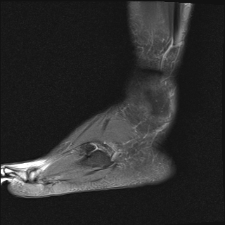 File:Achilles tendon tear (Radiopaedia 77615-89819 Sagittal PD fat sat 22).jpg